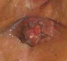 Zunanji hemoroidi fringe po odstranitvi hemoroide