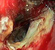 Raznovrstna rak želodca in njegova prognoza