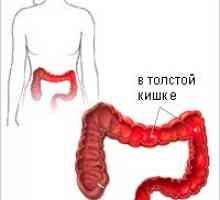 Ulcerozni kolitis