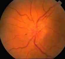 Optični nevritis: simptomi, zdravljenje, vzroki, diagnoza, prognoza