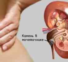 Neoplazme v ledvicah (hypernephroma)