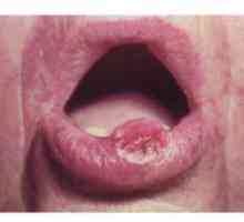 Neoplazme v ustni votlini pri ljudeh