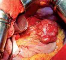 Tumorji v želodcu