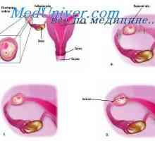 Pregled maternice. Pregled medenični votlini z zunajmaternične nosečnosti