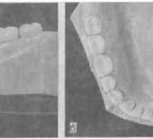 Ocena stanja zobovja