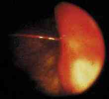 Oftalmologija računalniško termografijo pri diagnosticiranju malignih tumorjev očesa in orbite