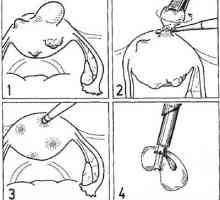 Operacijo na maternici. laparoskopski myomectomy