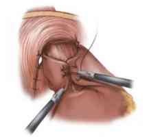 Kirurško zdravljenje refluksnega ezofagitisa in fundoplication