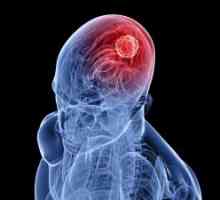 Možganski tumor, simptomi, zdravljenje, vzroki