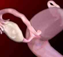 Jajčnikov tumorjev pri ženskah benignih in malignih: simptomi, zdravljenje, simptomi, vzroki