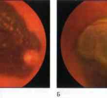 Tumorji mrežnice in žilnice: horoidna melanom