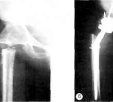 Zapleti po celotnega kolka artroplastiko: kolk motenj