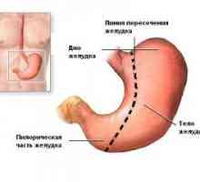 Zapleti želodca resekcijo in želodca