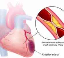 Akutni koronarni srčno popuščanje