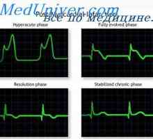 Akutni fazi miokardnega prednje stene. Miokardnega infarkta zadnje stene na EKG
