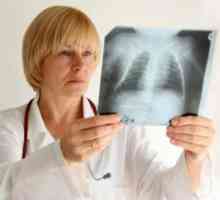 Akutni bronhitis, zdravljenje, simptomi, znaki, vzroki, preprečevanje, odkrivanje