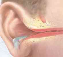 Akutni gnojno vnetje srednjega ušesa: zdravljenje, simptomi, znaki, vzroki