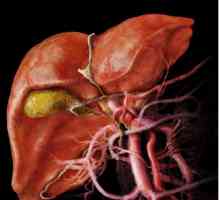 Pankreatitis in holelitiaza (holelitiaza, žolčnih kamnov)
