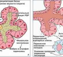Pankreatitis - bolezen trebušne slinavke: vzroki, etiologije patogeneze, klinične značilnosti,…