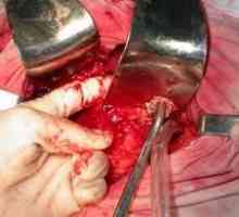 Pancreatonecrosis delovanje obdobje po operaciji