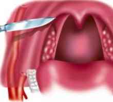 Peritonsillar absces in paratonzillit: zdravljenje, simptomi, vzroki, simptomi
