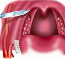 Peritonsillar absces: zdravljenje, simptomi, vzroki, simptomi