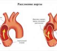 Aortna patologija v nosečnosti