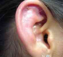 Perichondrium ušesa: zdravljenje, simptomi, znaki, vzroki