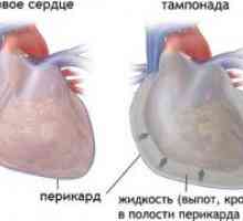 Perikardnem izliv in tamponada srca