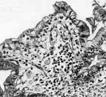 Cricoid (celica) želodca prognozo in zdravljenje raka