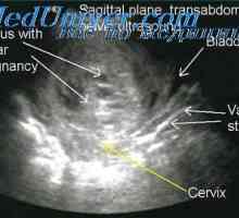 Primarni tumorji posteljico. placenta abscesi