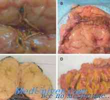 Primarni aldosteronizem (pov bolezen) morfologija, patološka anatomija