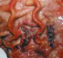 Ploščatocelični karcinom želodca
