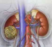 Karcinom ledvic: zdravljenje, simptomi, vzroki, simptomi