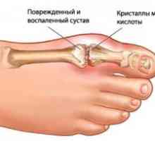 Protinski artritis sklepov: zdravljenje, simptomi, znaki, vzroki
