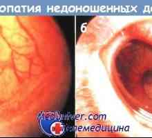Razvrstitev retinopatije prezgodaj rojenih otrok