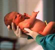 Malformacije novorojenčkih