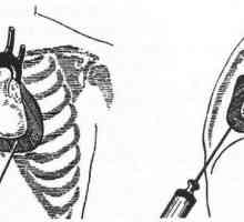 Poškodbe notranjih organov pri poškodbah prsnega koša