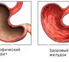 Uporaba Maalox gastritis