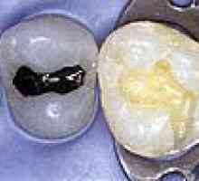 Neposredno estetsko obnovo posteriornih zob uporabo naprednih kompozitnih materialov