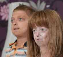 Progerija otroci: simptomi, zdravljenje, vzroki