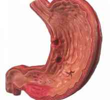 Manifestacije gastritis v želodcu, kot so simptomi?