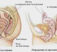 Prolaps maternice in vagine: zdravljenje, simptomi, kirurgija