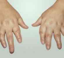 Psoriazni artritis: zdravljenje, simptomi, diagnosticiranje, simptomi, vzroki