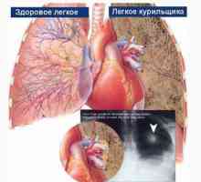 Bronhijev in pljučni rak, zdravljenje, simptomi, vzroki