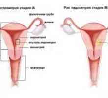 Rak endometrija: simptomi, oder, zdravljenje, diagnoza, prognoza, vzroki, simptomi, preprečevanje