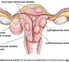 Rak maternice: faza, simptomi, zdravljenje, diagnozo