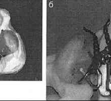 Zgodnje ortopedsko zdravljenje bolnikov z obojestransko heiloshize in neba z uporabo fiksnih naprav…
