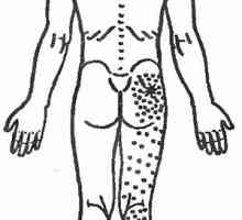 Raztezanje mišice v predelu medenice z bolečino v hrbtu