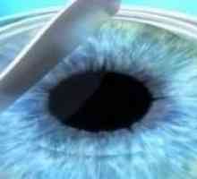 Kirurgija refrakcije oči: Kaj je to?